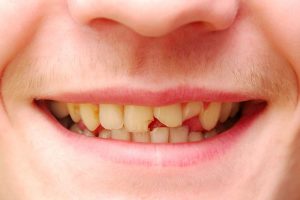 Broken Tooth on Adult Teeth