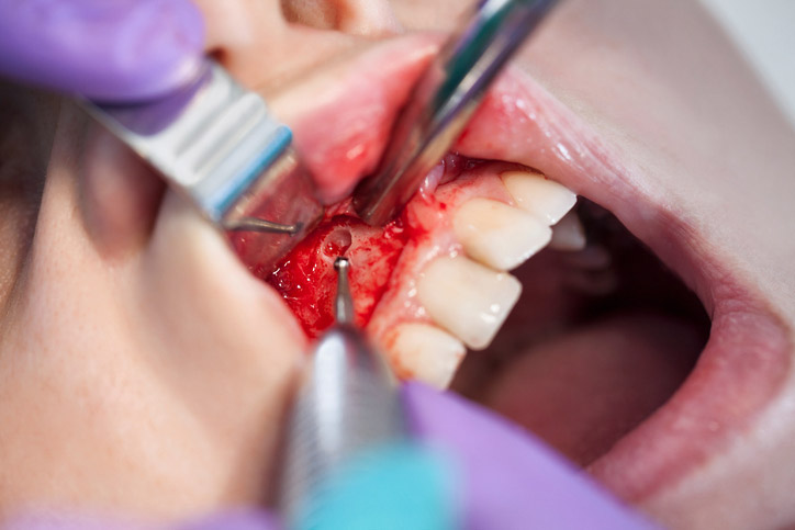 Jaw surgery can be performed