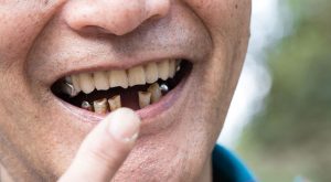 Partial dentures work by helping you if you are missing teeth