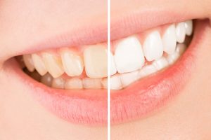 Signs and Symptoms of Clear Teeth