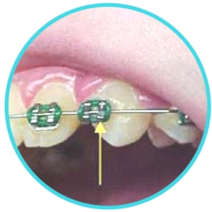 broken or loose braces image