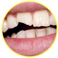 chipped or broken tooth image