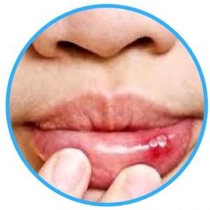 lips injury image