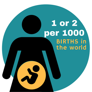 BIRTHS cleft palate