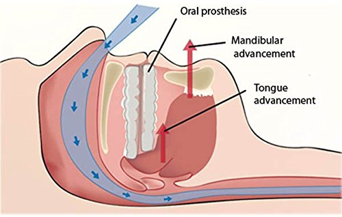Best Sleep Apnea Mouth Guard