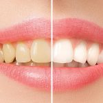 Best Whitening Mouthwash What to Look For