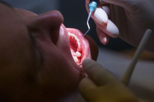 Bleeding gums