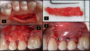 Bone grafts