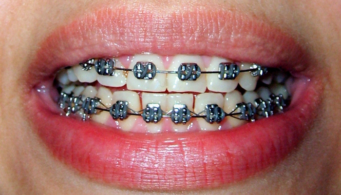 braces image