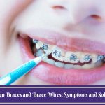 Broken Braces and Brace Wires