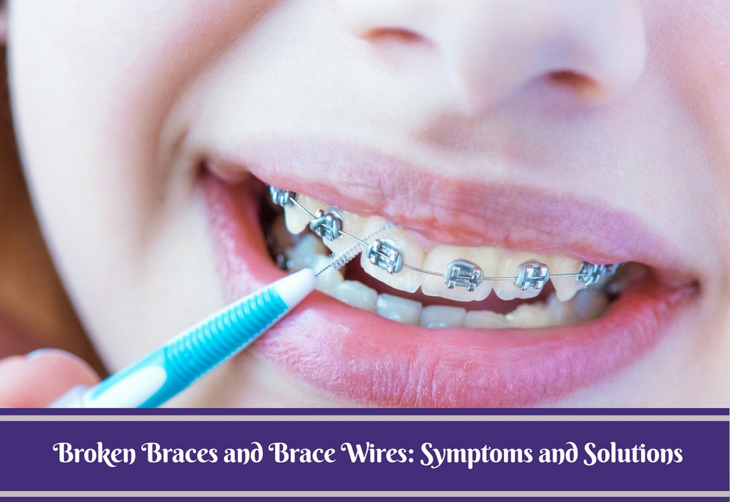Broken sales braces wire