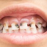 Bulimia Teeth Damage What You Need to Know and How to Stop It