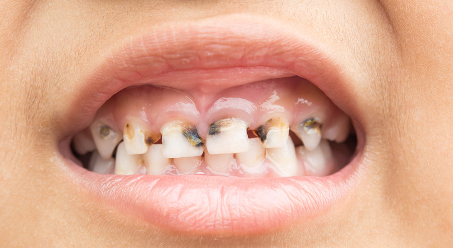 Bulimia Teeth Damage What You Need to Know and How to Stop It