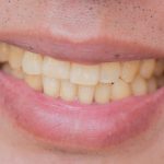 Causes of Yellow Stains on Teeth