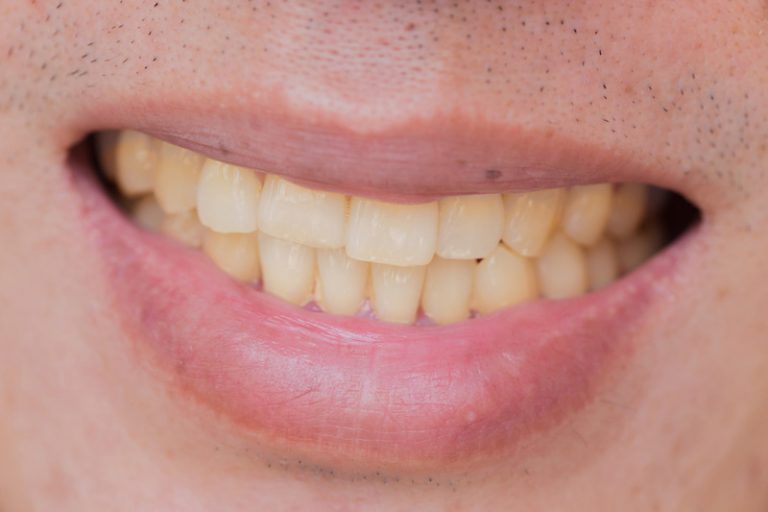 8-major-causes-of-yellow-stains-on-teeth