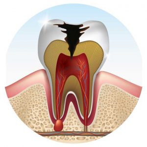 what is a Cavity