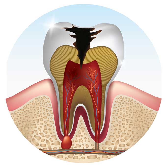 Wisdom Tooth Cavity Symptoms and Treatment Options