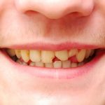 Cracked Front Tooth Here Are Five Things You Should Do Right Away