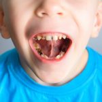 Craze Lines on Teeth What Are They and What Do You Do