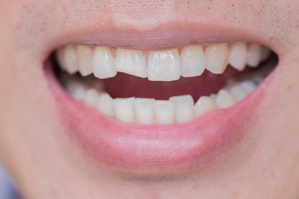 Dental Bonding vs. Veneers The Difference