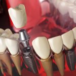 Dental Bridge vs. Implant- Finding What’s Best for You