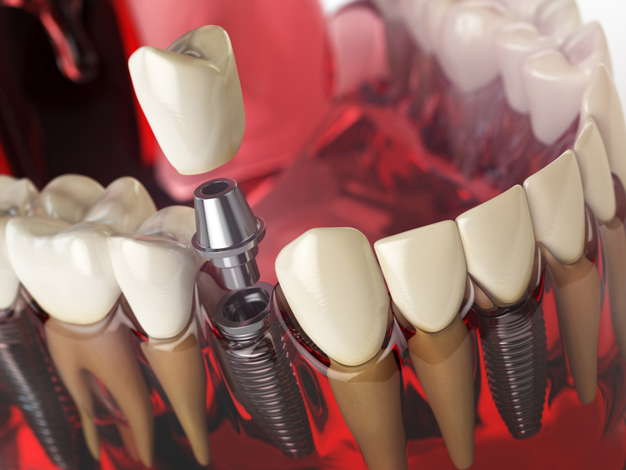 Dental Bridge vs. Implant- Finding What’s Best for You