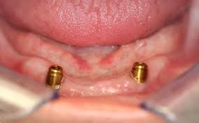 Dental Implants 1