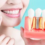 Dental Implants vs. Bridges Which One is Better