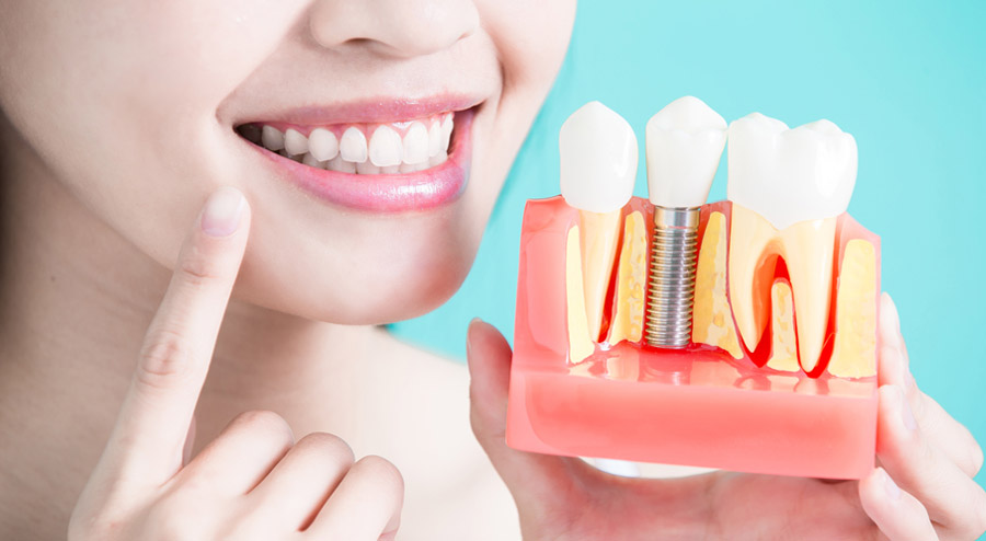 Dental Implants vs. Bridges Which One is Better