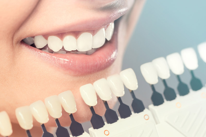 Dental Plastic Veneer Production Process