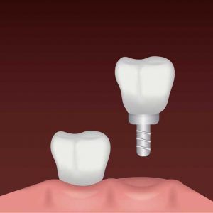 Dental-crowns