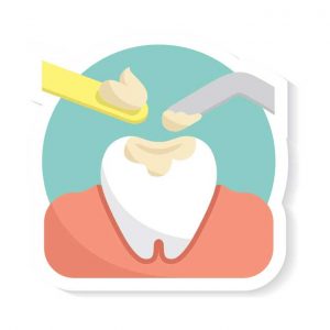 Dental-filling