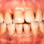Dip Gum Disease and How Tobacco Effects Your Oral Health