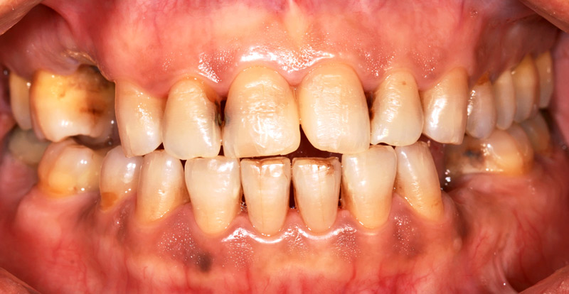 Dip Gum Disease and How Tobacco Effects Your Oral Health