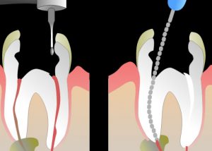 Endodontic therapy