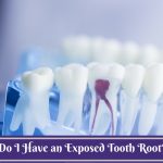 Exposed Tooth Root