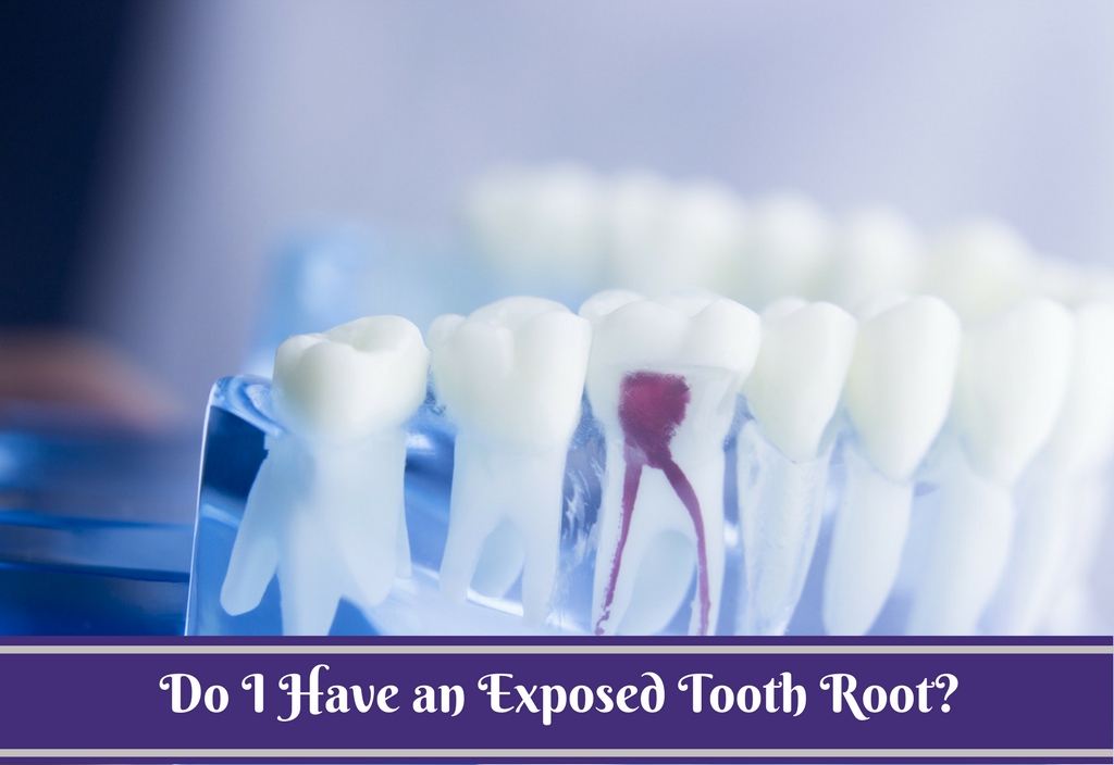 Exposed Tooth Root