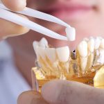 Fixed Dental Implant Bridge vs. Implant Denture- What is the REAL Difference