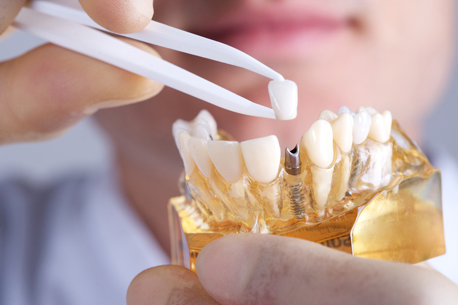Fixed Dental Implant Bridge vs. Implant Denture- What is the REAL Difference