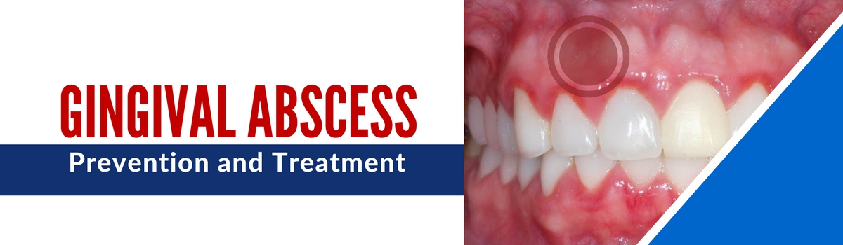 Gingival Abscess