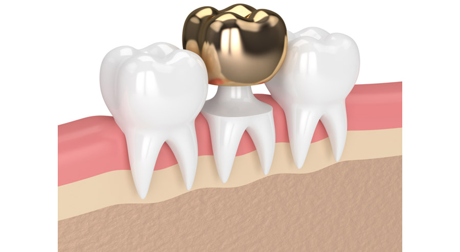 Gold Crown Tooth FAQs