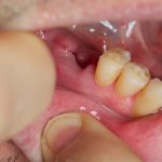 Gum Abscess Home Remedy 10 Remedies You Should Know About