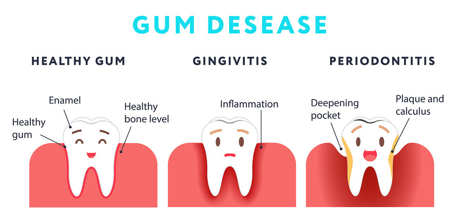 Gum Disease