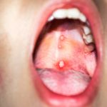 Hard Bump on Roof of Mouth Possible Causes and Medical Suggestions