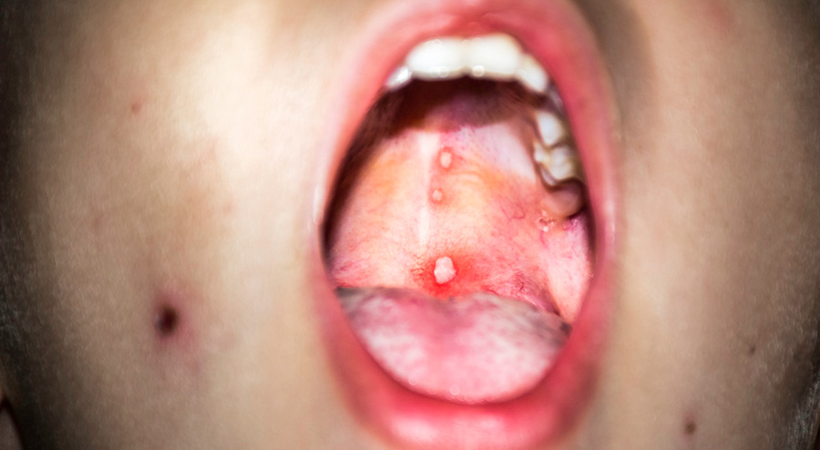 Hard Bump on Roof of Mouth Possible Causes & Medical Suggestions
