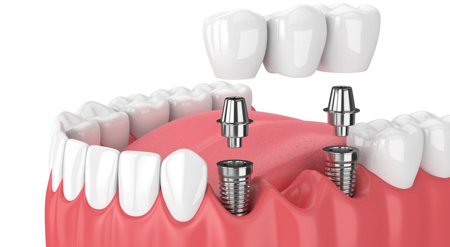 How Do Dental Bridges Work