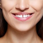 How Do Teeth Gap Bands Work