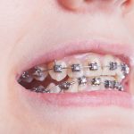 How Do Underbite Braces Work