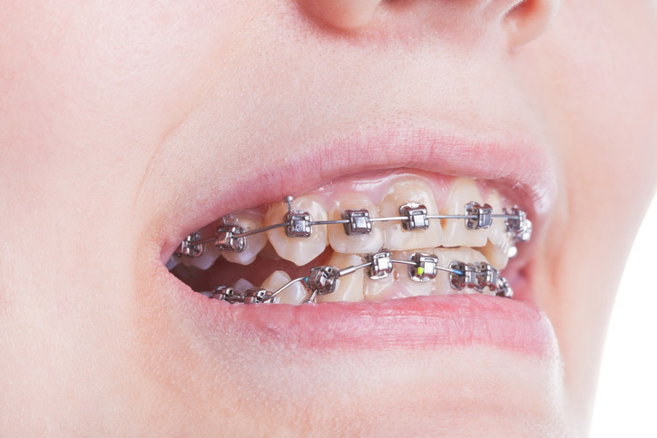 How Do Underbite Braces Work