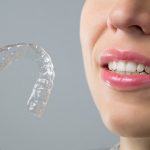 How Does Invisalign Work